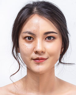 IPL Pigment Removal Near Me in Avon, CT