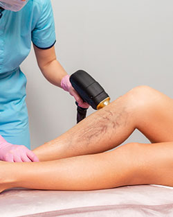 Laser Vein Removal Near Me in Avon, CT