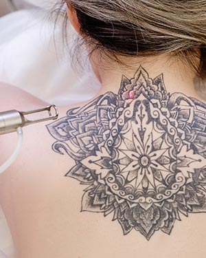 Tattoo Removal Near Me in Avon, CT