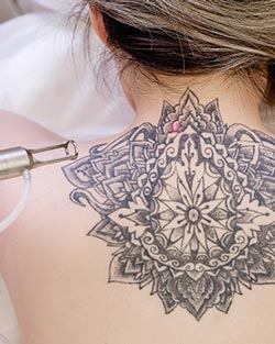 Tattoo Removal Near Me in Avon, CT