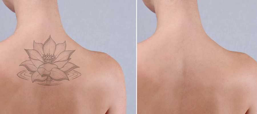 What to Expect Before and After Tattoo Removal Near Me in Avon, CT